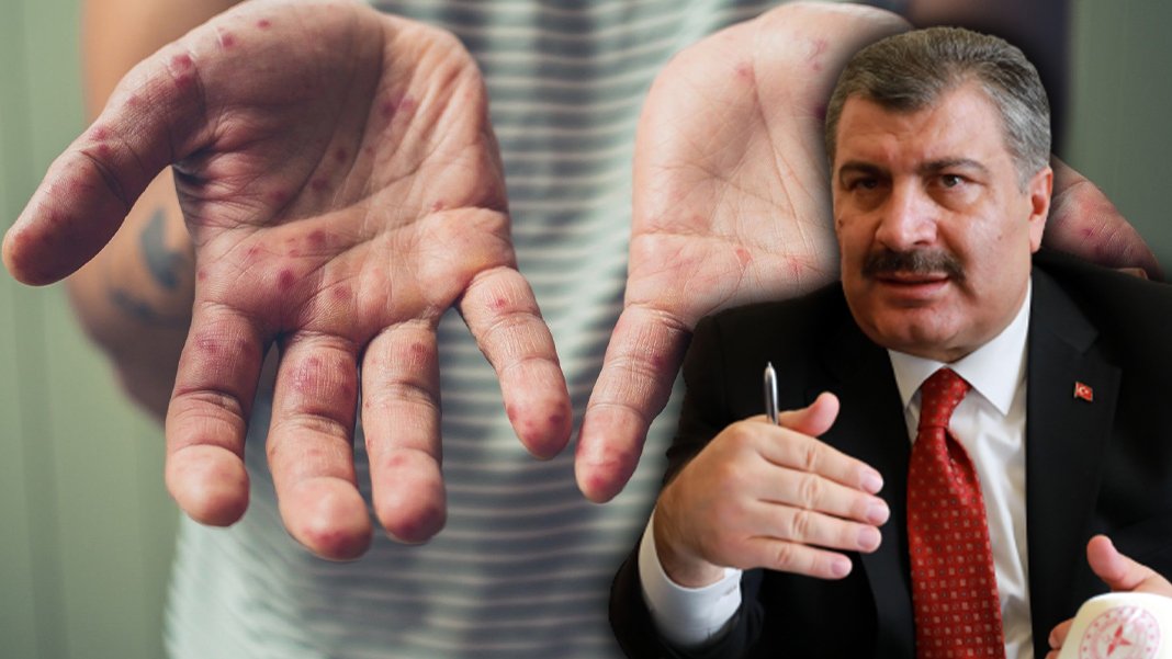 Bakan Koca'dan can kaybı iddialarına açıklama: Kızamık değil HIV kaynaklı ölüm