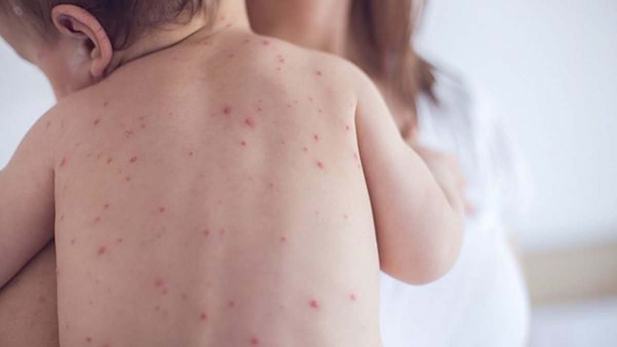 Vaka sayısı her geçen gün artıyor! Uzmanlar endişeli: Bu önlemler derhal alınmalı, yoksa...