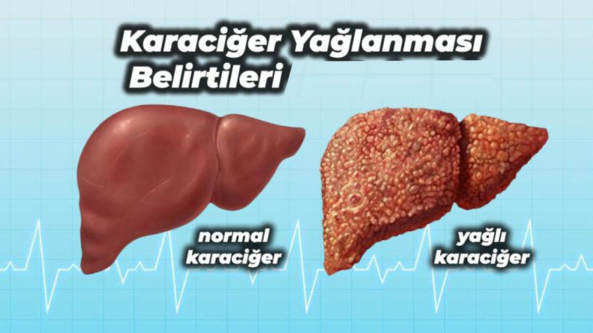 Karaciğer yağlanması belirtileri
