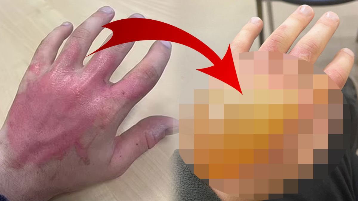 Bisiklet sürerken bu bitkiye değdi, eli davul gibi şişti! Aman dikkat, bu bitkiden uzak durun