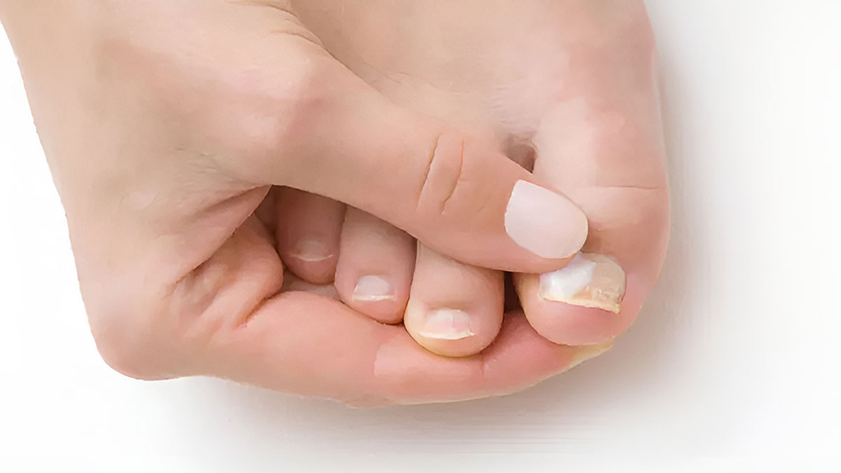 Her evde bulunan bu malzemeyle tırnak mantarının kökünü kurutun! Mucizevi doğal formül tek seferde mantarı temizliyor