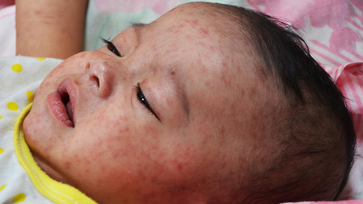 Anne-babalar dikkat: Çocuklarınızı kızamık riskinden korumak için bunları yapın! Dört kurumdan 'Acil' kodlu uyarı