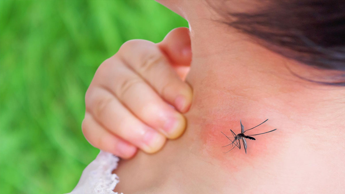 Sinek ısırığını şipşak geçiriyor! Sürün 5 dakika bekleyin