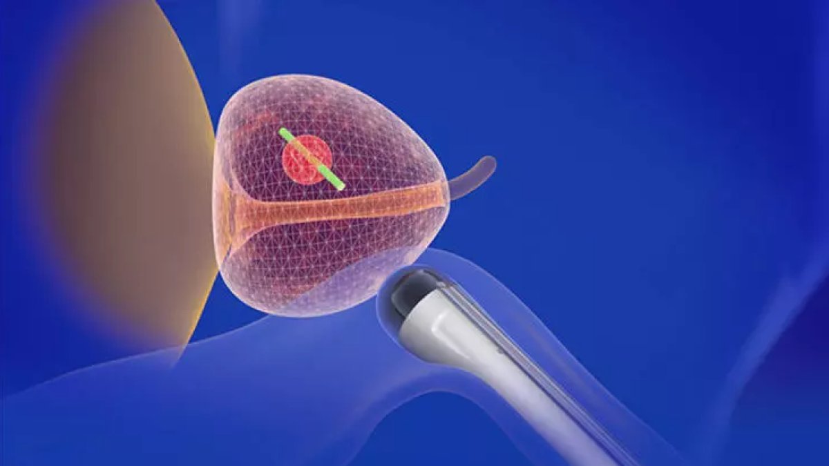 Biyopsi Nedir: Tıbbın Bilgi Hazinesinden Bir Parça