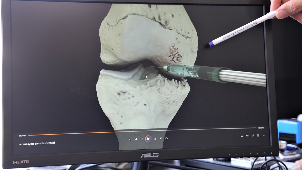 Diz kireçlenmelerine ameliyatsız çözüm: Hidrojel tedavisi geliştirildi