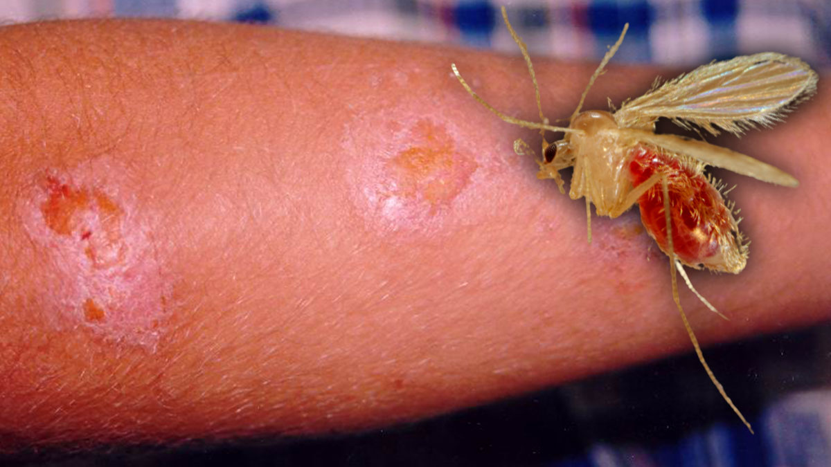 Kan emen 'yakağan sineği' ısırdığı kişinin karaciğerini bitiriyor! Gözle görülemeyecek kadar küçük