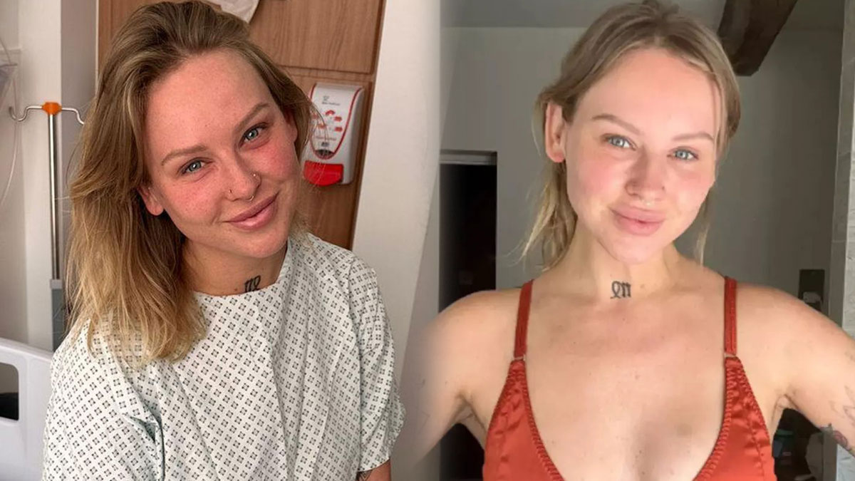 Göğüs estetiği yaptırdı, kör oldu! Ameliyattan yıllar sonra kabusu yaşadı, cildi kurudu, egzama nöbetleri geçirdi