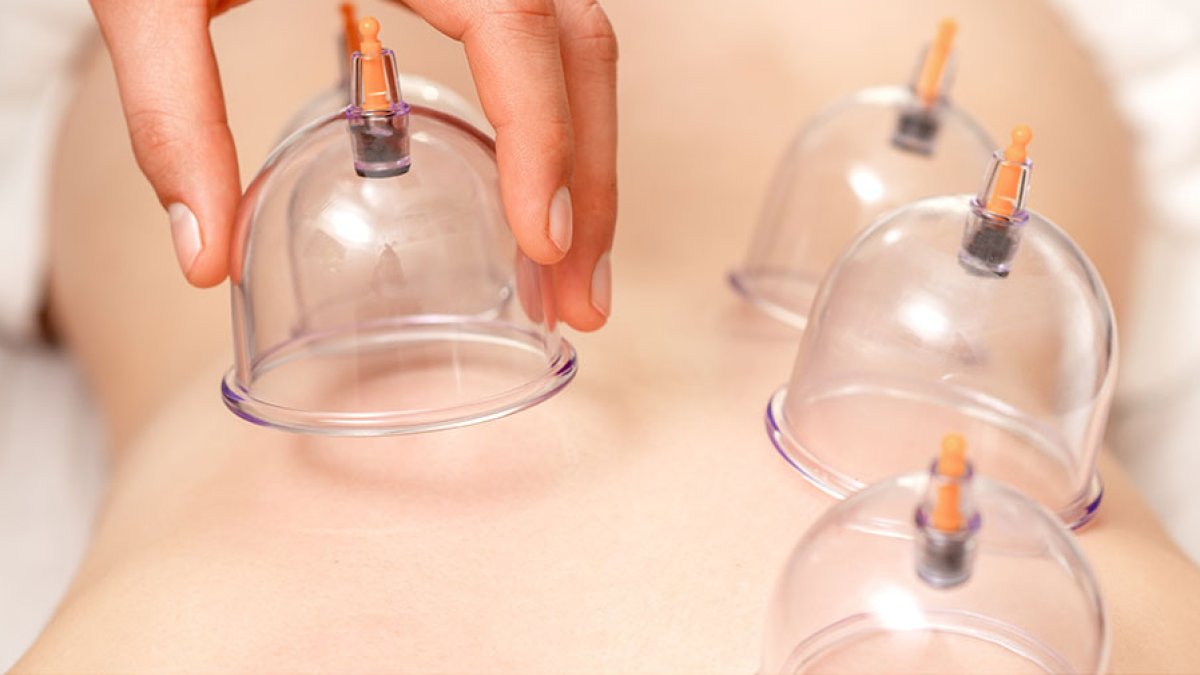 Hacamatın Faydaları: Vücudunuza Yararlı Bir Terapi Yöntemi