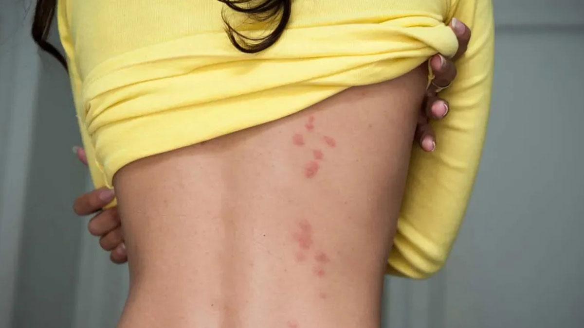 Sivrisinek kaynaklı o hastalık 20 yıl sonra ortaya çıktı! Halk sağlığı tehlike altında, kurumlar alarma geçti