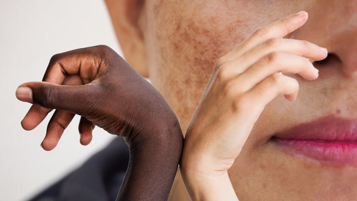 ABD'li bilim insanları ortaya çıkardı: Cilt rengiyle ilişkili 135 yeni gen tespit edildi