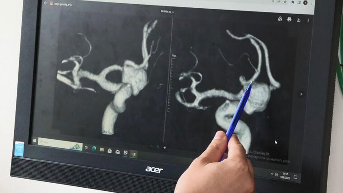 Her yıl binlerce kişinin ölümüne neden oluyor... Beyin anevrizmasında yeni keşif