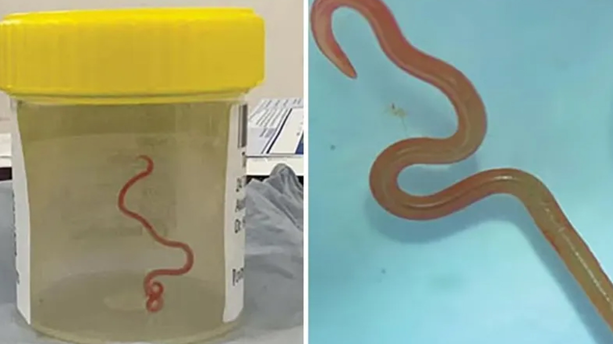 Unutkanlık şikayetiyle gitti hayatının şokunu yaşadı: Beyninde 8 santimetrelik solucan çıktı