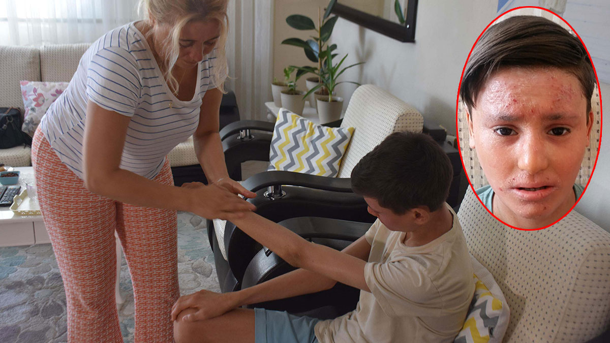 Merhamet kalmamış... Nadir görülen hastalıktan değil, çevredeki insanların bakışları ve tuhaf soruları aileyi bezdirdi!