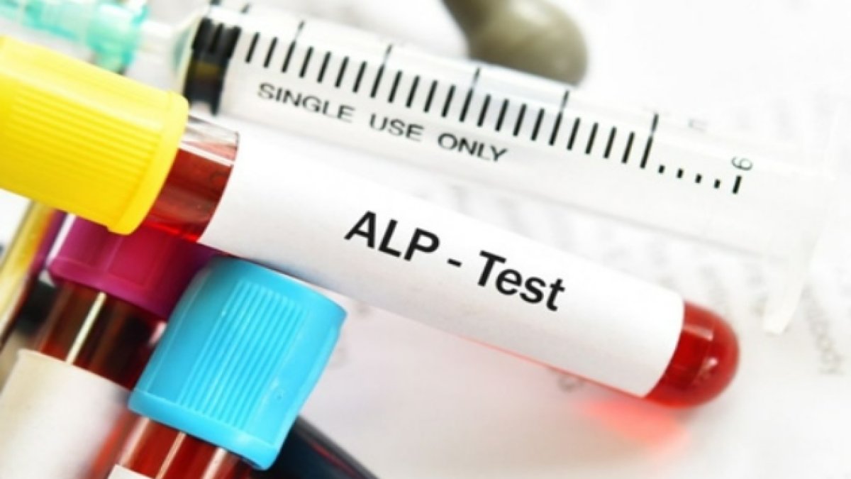 Alkalen Fosfataz Yüksekliği Nedenleri: Vücut İşaretçisi ve Olası Sebepler