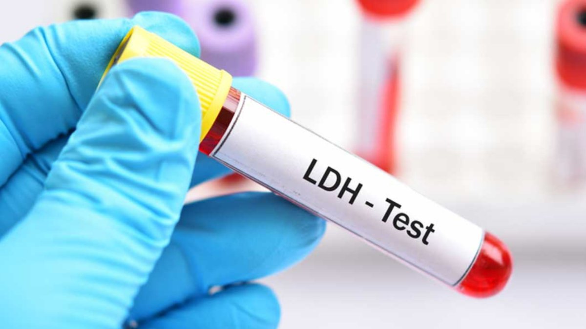 LDH Ne Kadar Yüksek Olursa Tehlikelidir: Sağlık İçin Önemi ve Anlamı