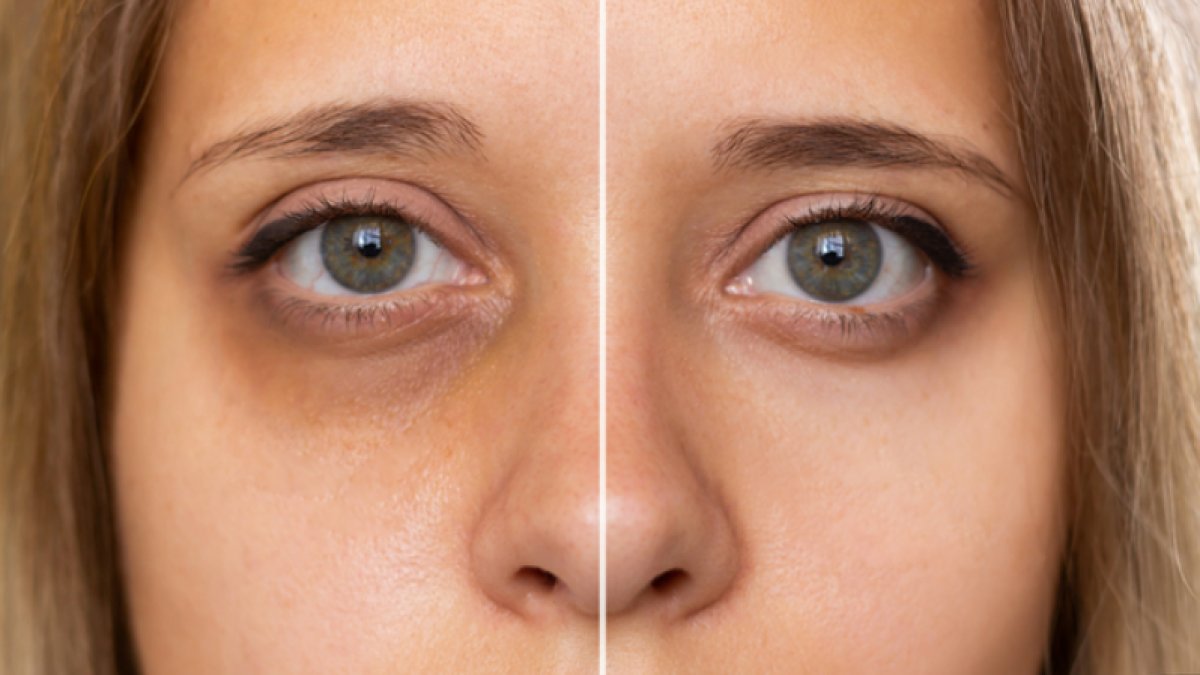 Göz Altı Morluklarına Ne İyi Gelir: Doğal Çözümler ve Etkili Öneriler