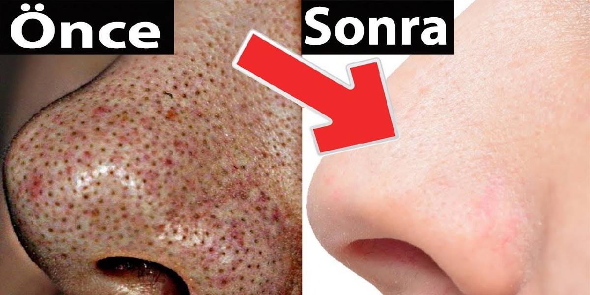 Siyah noktalara veda zamanı geldi! Tek bir yöntemle saniyeler içinde yok edin… Korelilerin popüler yöntemi ifşa oldu