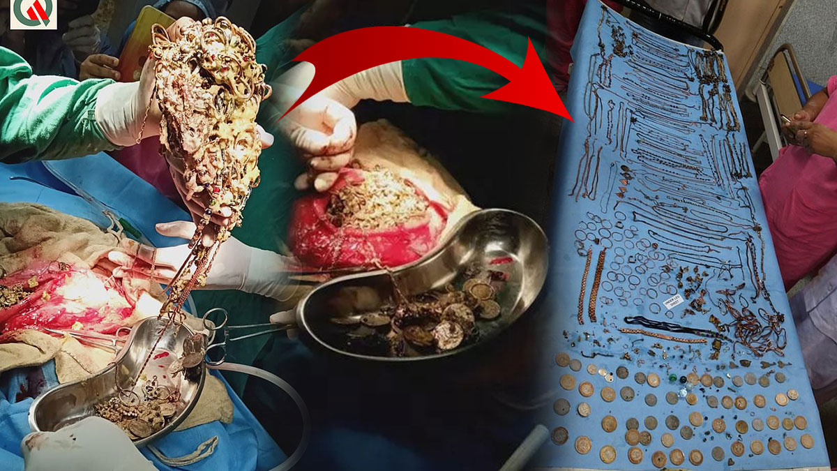 Midesinden çıkanlarla züccaciye dükkanı açılır! Karın ağrısıyla gitti, şoke eden gerçek ortaya çıktı