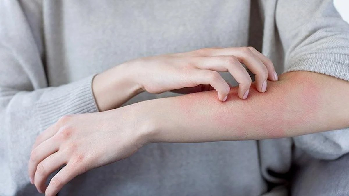 Pandemi vatandaşı 'uyuz' etti: Vakalar yüzde 50 arttı