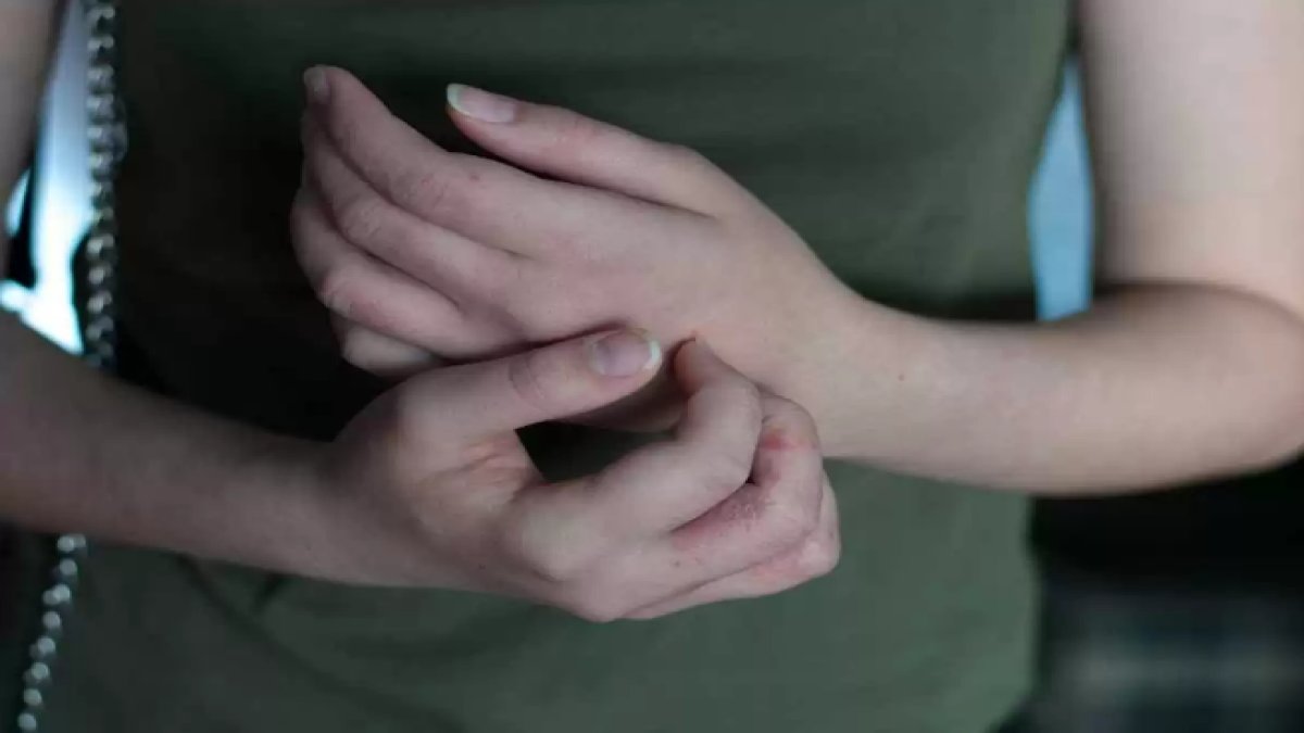 Uyuzun Bittiğini Nasıl Anlarız: Belirtiler ve Tedavi