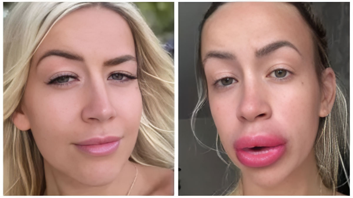 Dudak dolgusunun erimesiyle alerjik reaksiyon gösteren kadın, hastanelik oldu! Yanlış dudak dolgusu, körlüğe neden olabilir