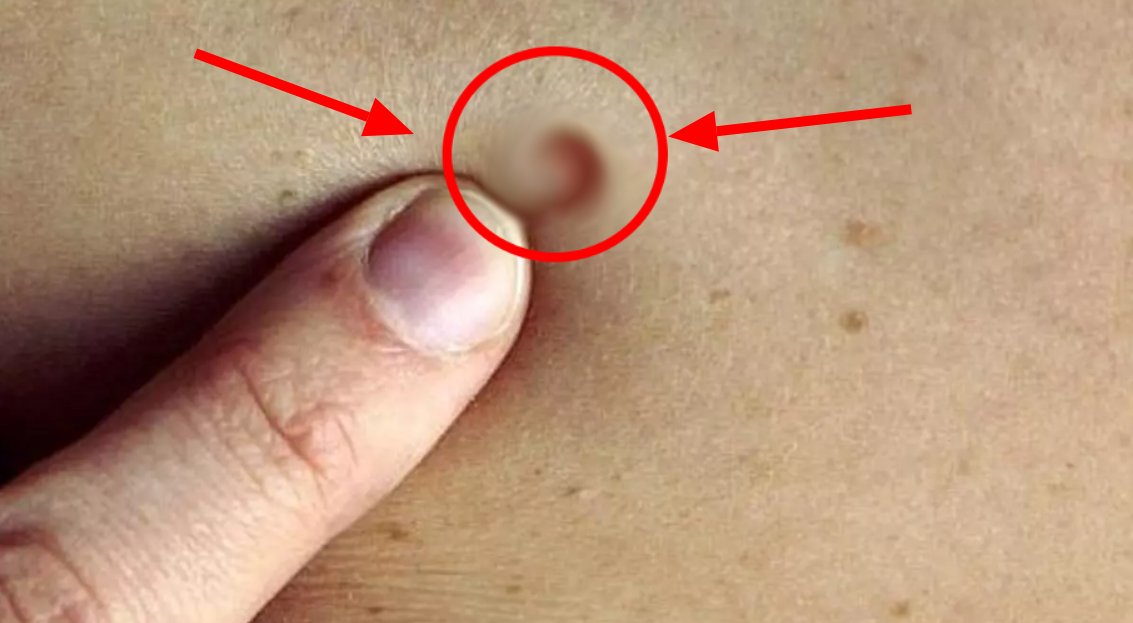 Ben lekeniz sizin sağlığınızı ele veriyor! Eğer ben lekeniz böyleyse dikkat! Bir doktora mutlaka gidin