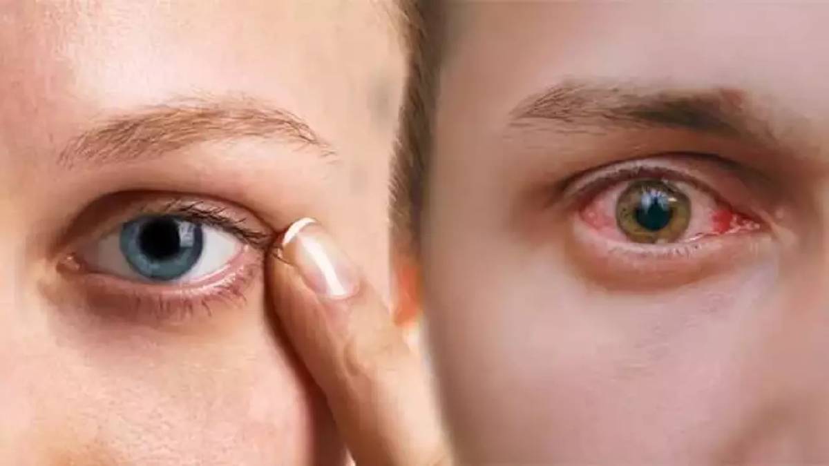 Uzmanlar üstüne basa basa uyardı! Gözlerinizde bu belirti varsa acil doktora gidin... Vakalar artmaya başladı