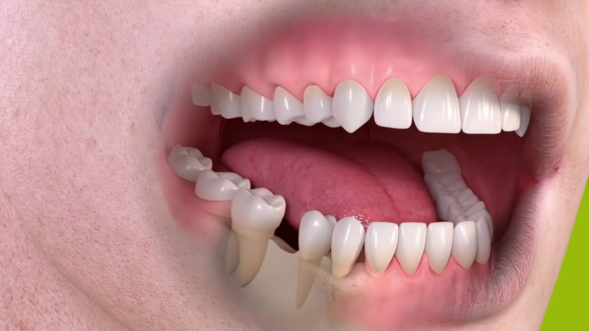 Dişimi kaybettim diye dertlenmeyin! Bunu sürün dişiniz anında geri gelsin... Bilim insanları bir mucizeyi başardı