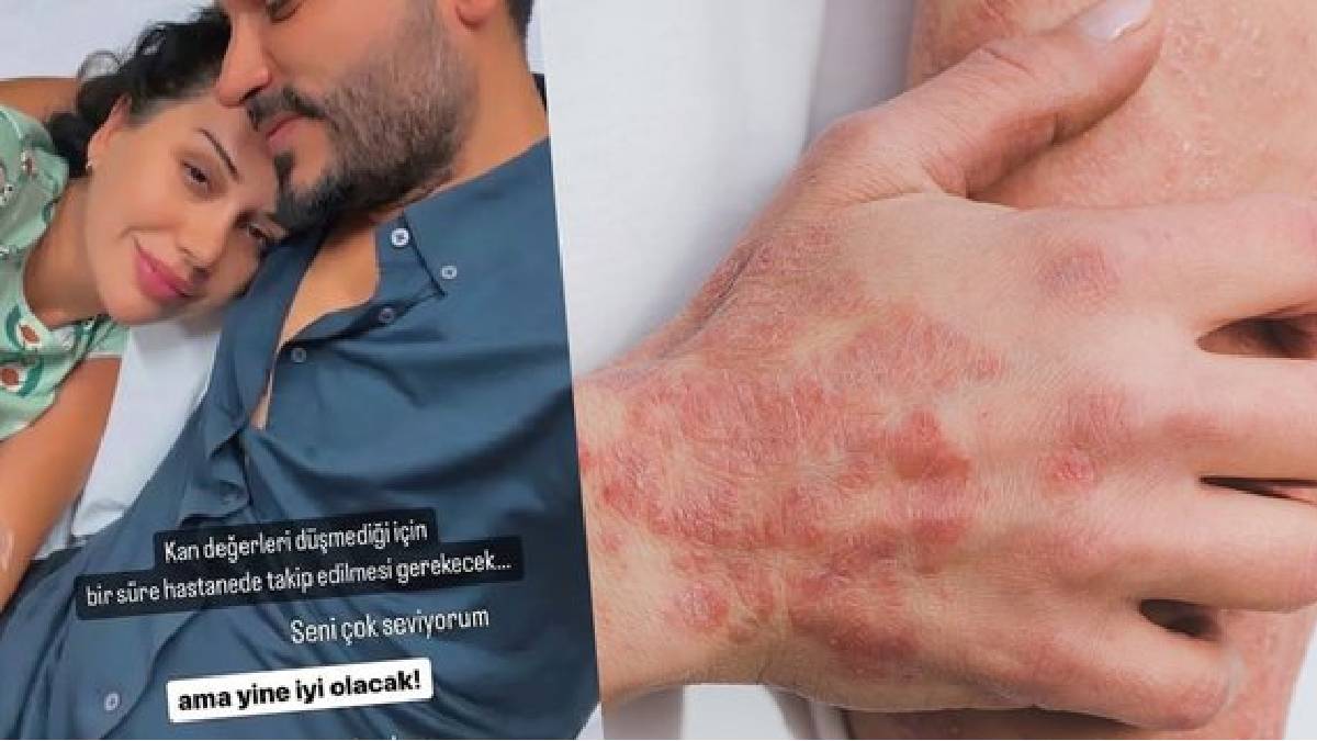Dilan Polat’ın hasta olduğu ortaya çıktı! Kelebek hastalığı merak konusu oldu… Yavaş yavaş bağışıklığı düşürüyor…