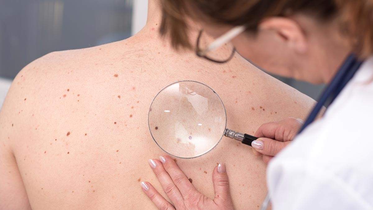 Cildindeki bu lekeleri hafife alan hayatının hatasını yapar! Hemen doktora koşun: Hepsi birer kanser belirtisi