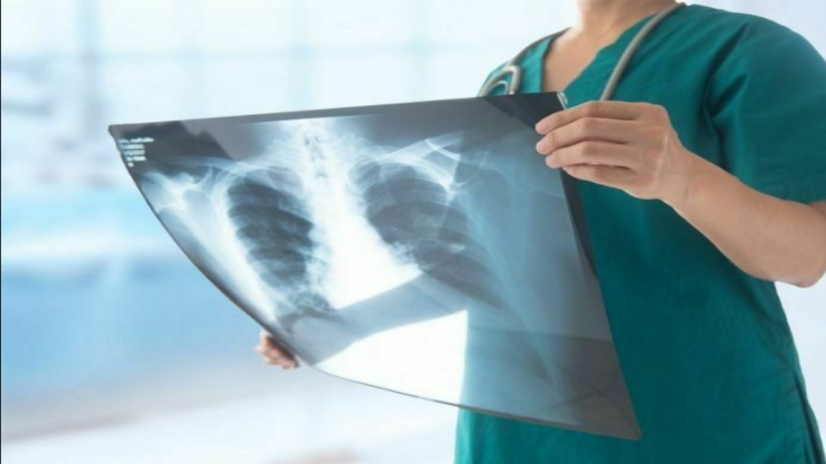 Akciğer Filmi Nasıl Çekilir: Sağlıkta Görüntüleme İşlemi