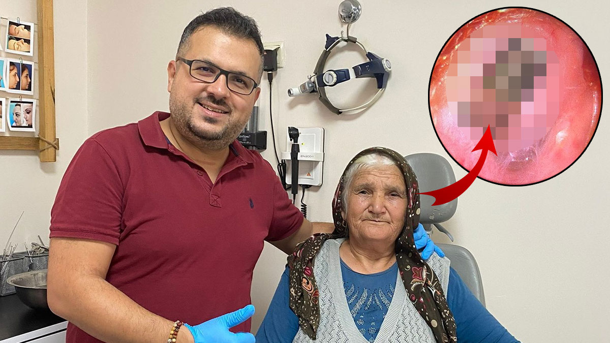 Uğultu şikayetiyle doktora gitti, kulağından canlı canlı çıkarıldı! Meğer haşere yuva yapmış