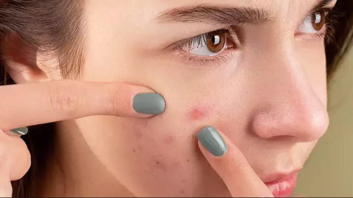 Yanakta Sivilce Neden Çıkar: Sorunun Kökenleri ve Çözüm Yolları