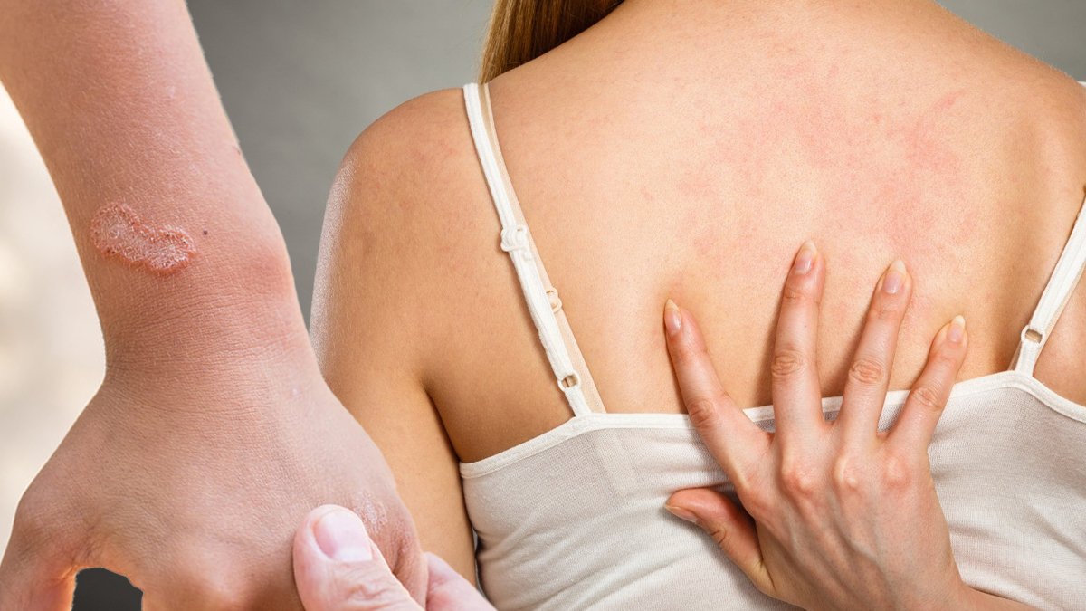 Polikliniklerin yüzde 30'u uyuz vakası: Yeni salgın kapıda mı?