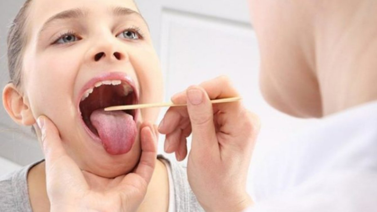 Tonsilit Nedir: Boğazın Savunma Kalkanı