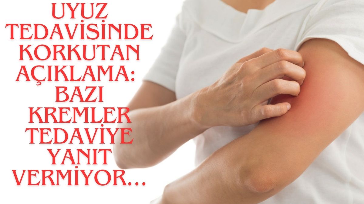 Sirkeli su uyuzu geçirir mi? Doktorlardan korkutan açıklama: Kremler de tedaviye yanıt vermiyor…
