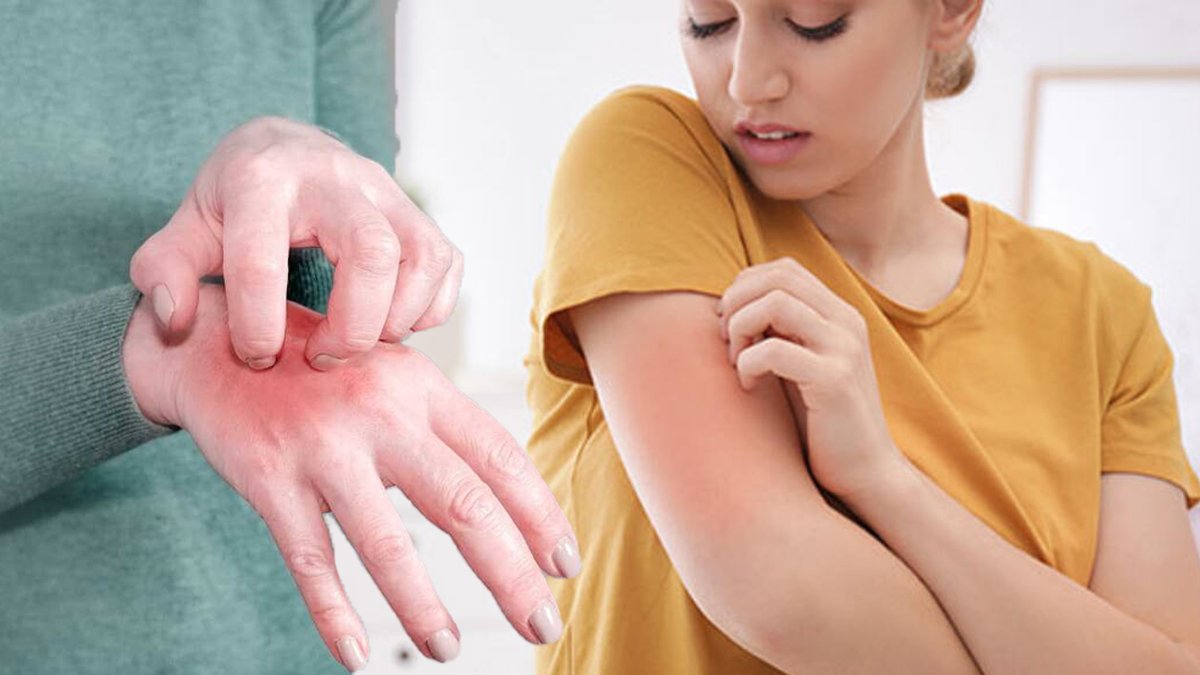 Uyuz vakaları arttı uzmanı uyardı: Mağazada kıyafet denerken dikkat edin