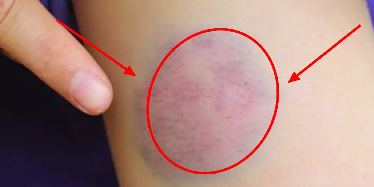 Cildiniz hemen morarıyorsa dikkat! Küçük çarpmalarda bile morluk oluyor ihmal etmeyin, nedeni bu olabilir