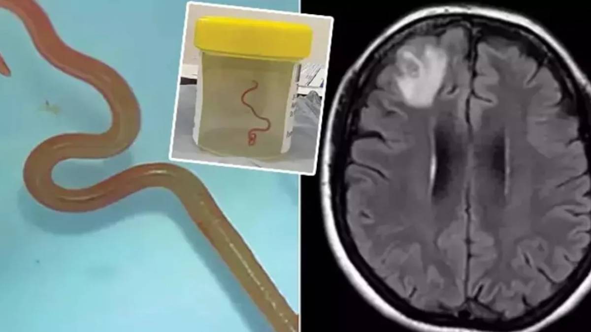 Unutkanlık başlayınca ortaya çıktı! Yılanlarda görülen solucan kadının beyninde çıktı... İkisi de hala hayatta
