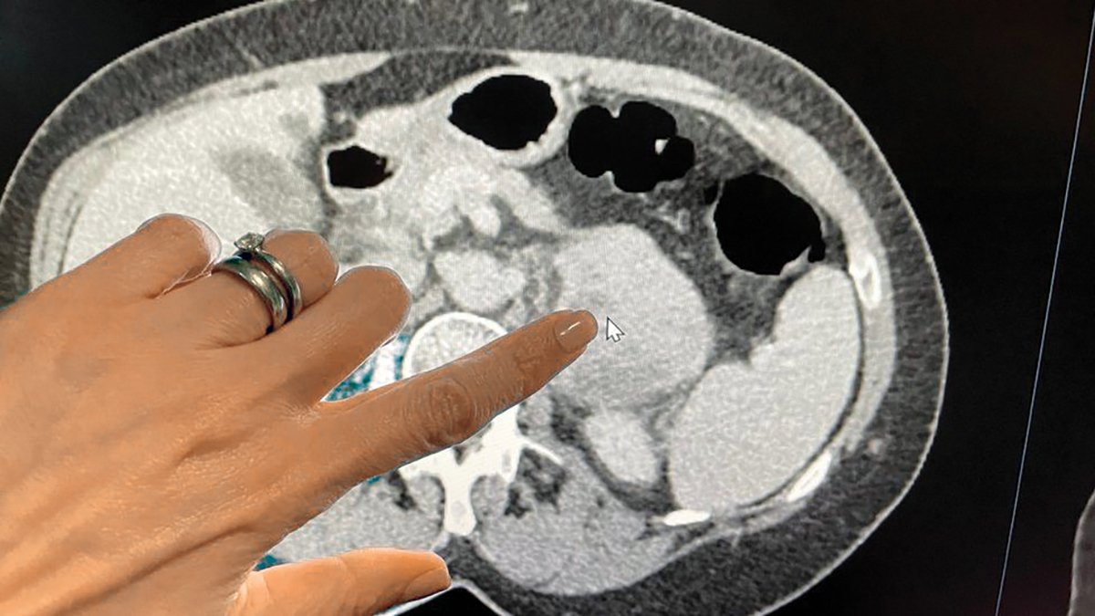 Kansere yapay zeka darbesi