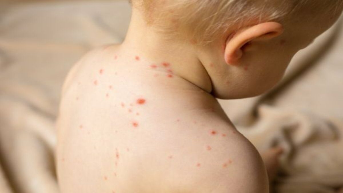 Su Çiçeği Belirtileri: Su Çiçeği Nedir ve Nasıl Tanımlanır?