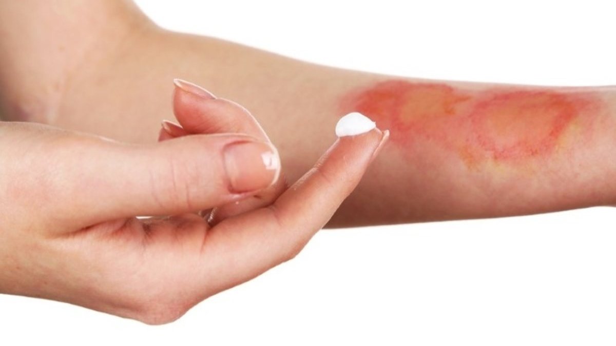 Eski yanık izlerinden bile eser bırakmıyor! En etkili yanık izi geçirme formülü: Karıştırıp sürünce hiç yanmamış gibi olacak