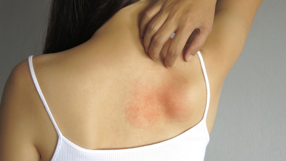 Sırtta Sivilce Neden Çıkar?