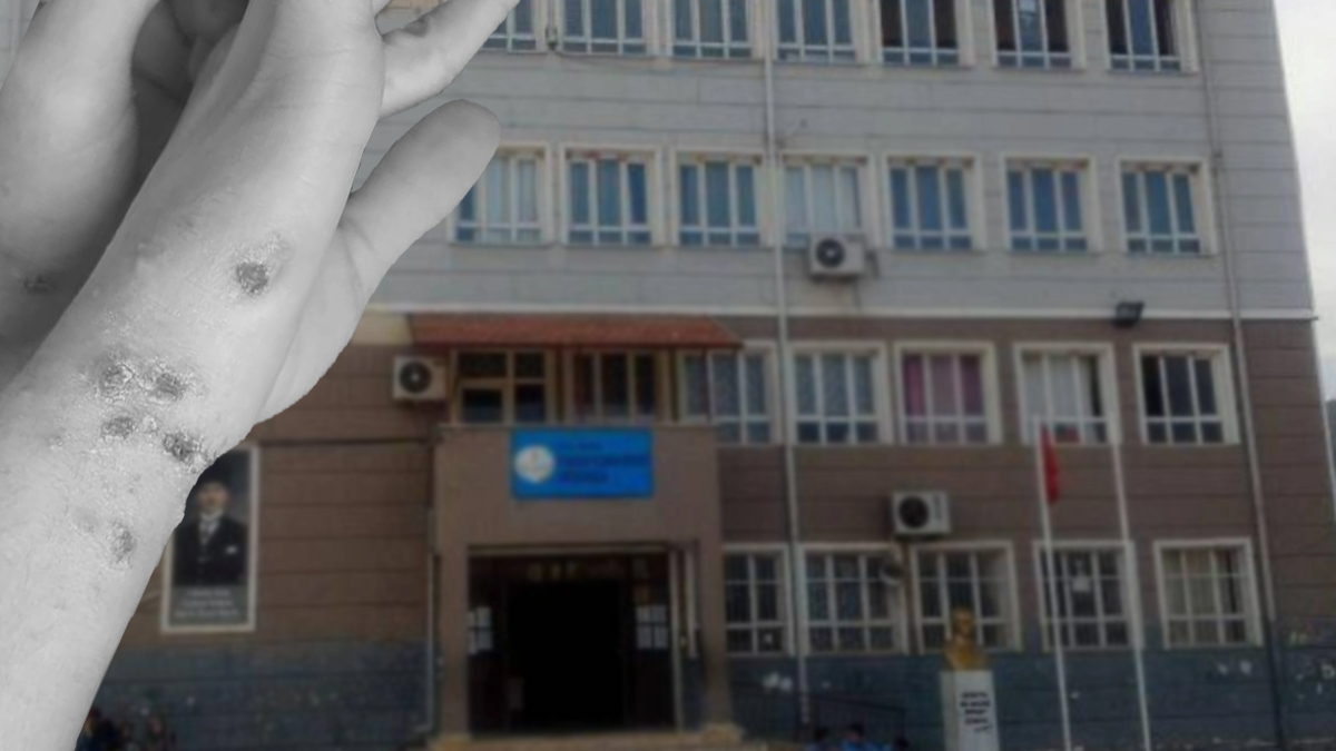 Deprem bölgesinde 'uyuz' tehdidi: Öğrenciler arasında hızla yayılıyor