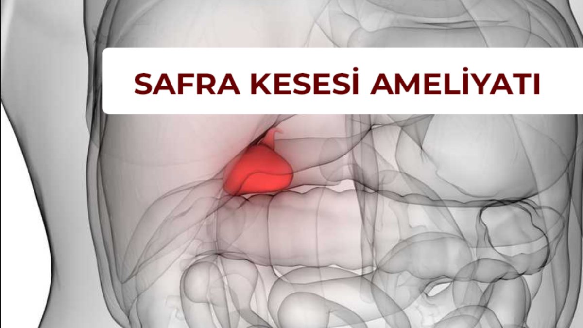 Safra Kesesi Ameliyatı Sonrası: İyileşme Süreci ve İpuçları