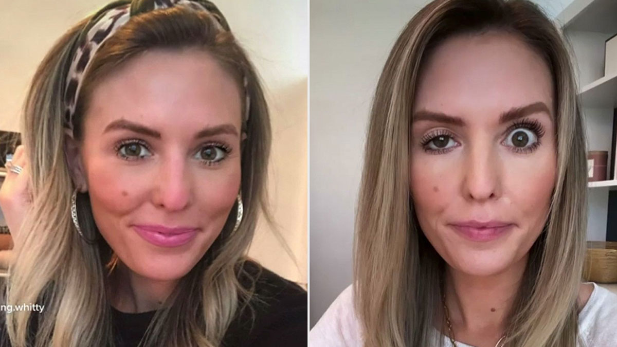 Ucuz botoks kampanyalarına kanmayın: 14 gün sonra çift görürsünüz! Kaşlarınız düşer, yüzünüz asimetrik kalır