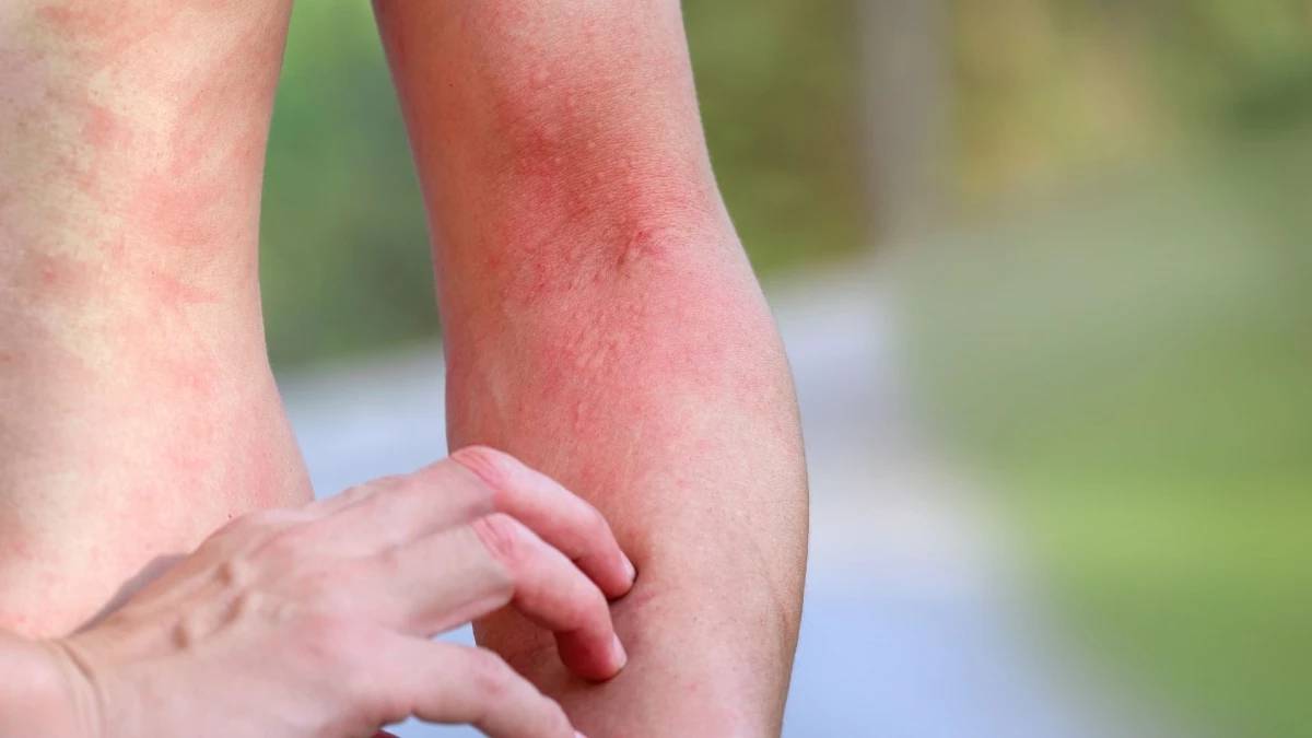 Uyuz hastalığı nasıl geçer?