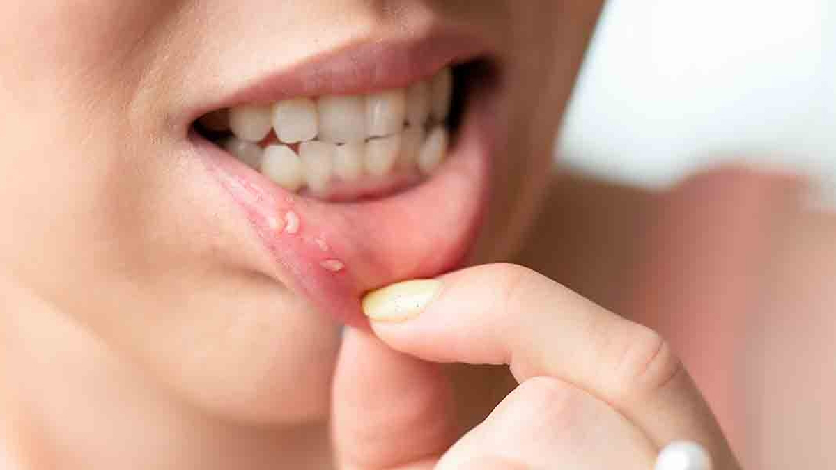 Ağız içi yaralarına ne iyi gelir?