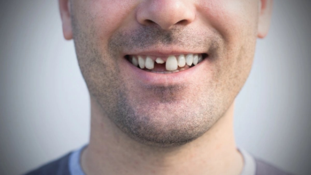Rüyada Dişinin Kırıldığını Görmek: Anlamı ve İşaretleri