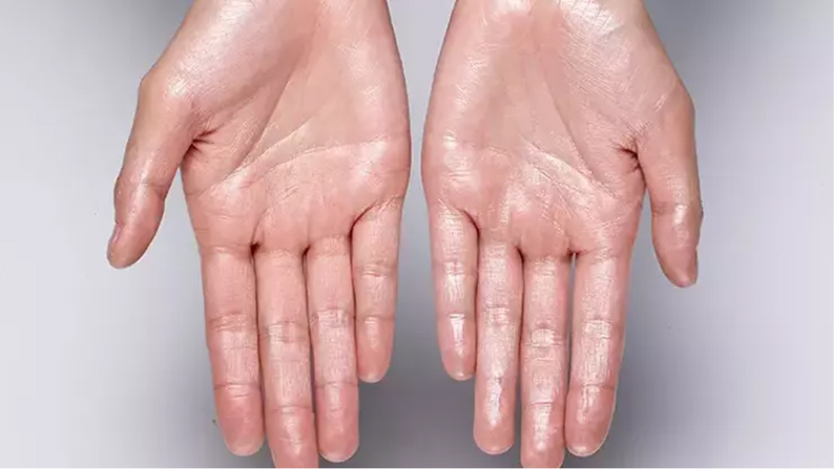 El terlemesi neden olur?